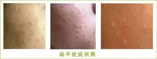看扁平疣到福州市皮肤病医院